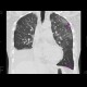 Wegener's vasculitis, sequel of pneumorhagia, alveolar bleeding: CT - Computed tomography